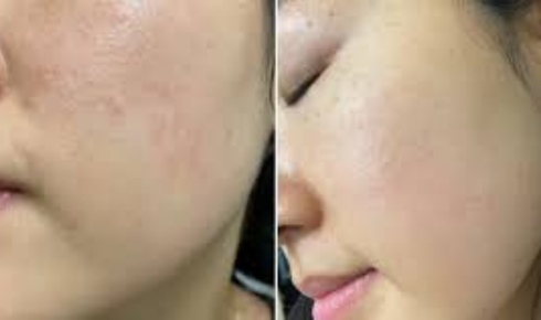 Skin Cycling Trend Does It Actually Work for Acne
